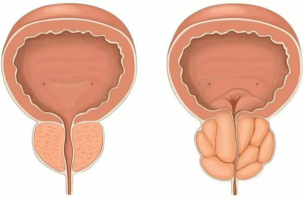 Prostatite et prostate saine