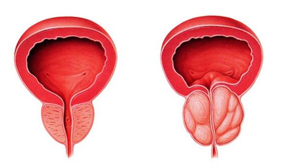 Prostate normale et enflammée (prostatite)