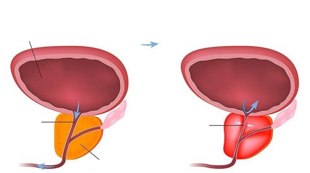 prostate normale et enflée